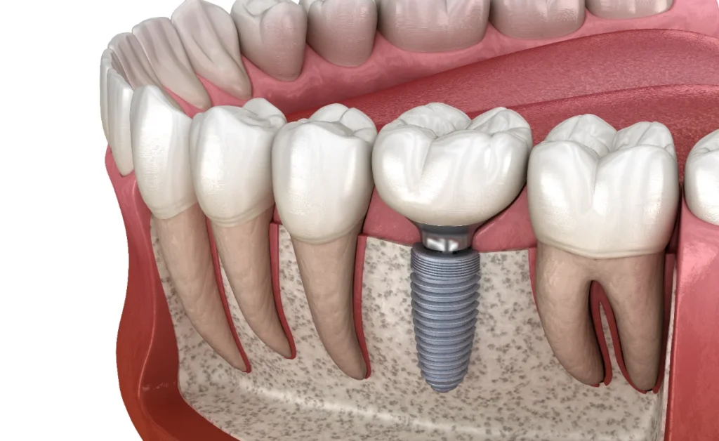 Implante dentário unitário — render 3D anatómico