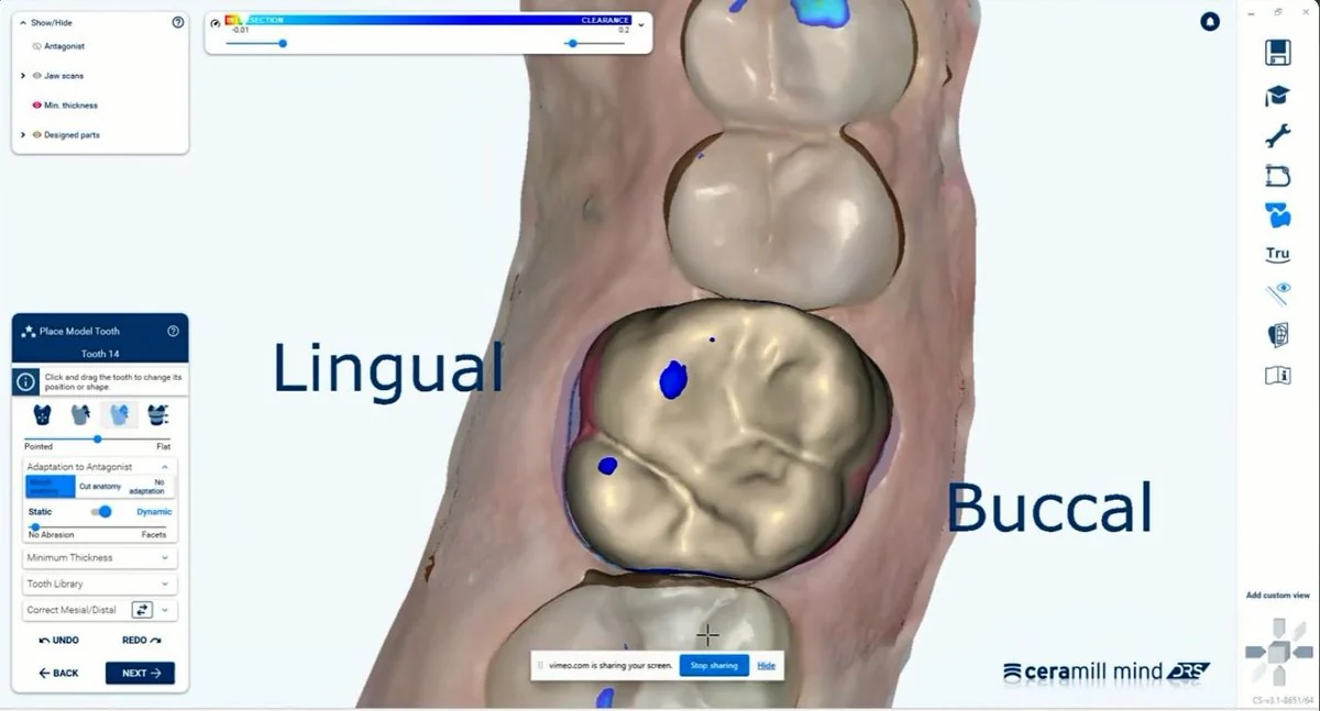 Software Ceramill mind DRS — desenho da peça na clínica