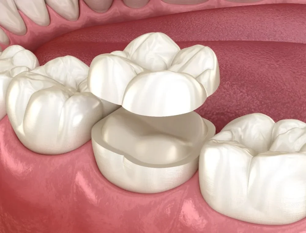 Restauração cerâmica colocada sobre o dente natural — render 3D