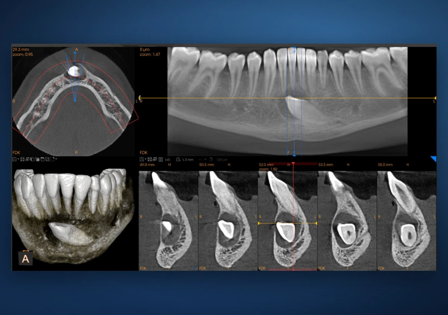 Visualização por cortes de um dente em CBCT