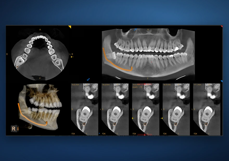 CBCT 3D / TAC Dentária