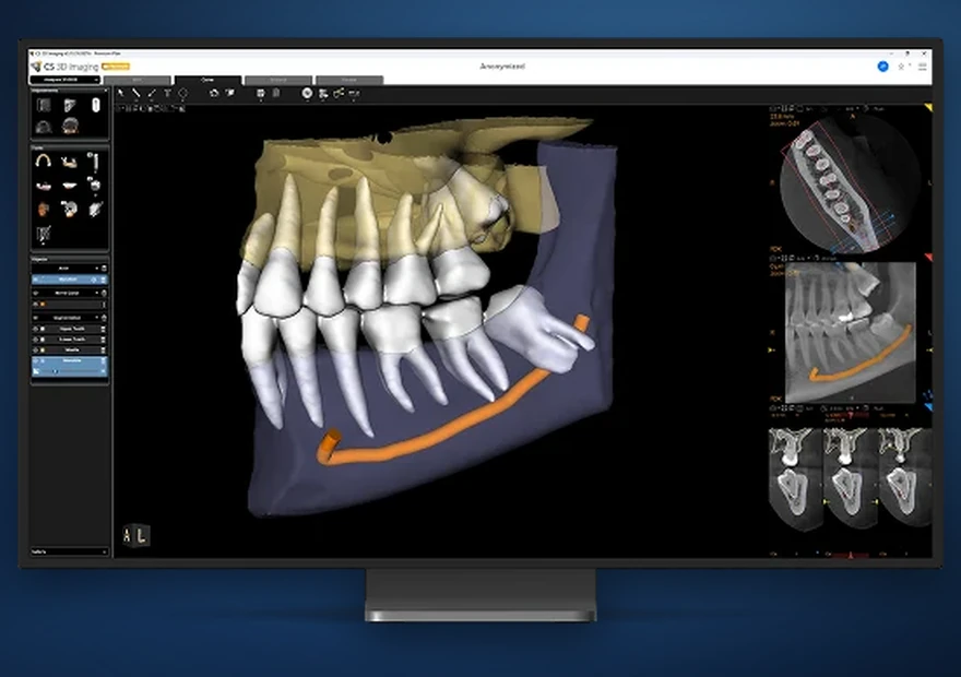 Planeamento de implantes
