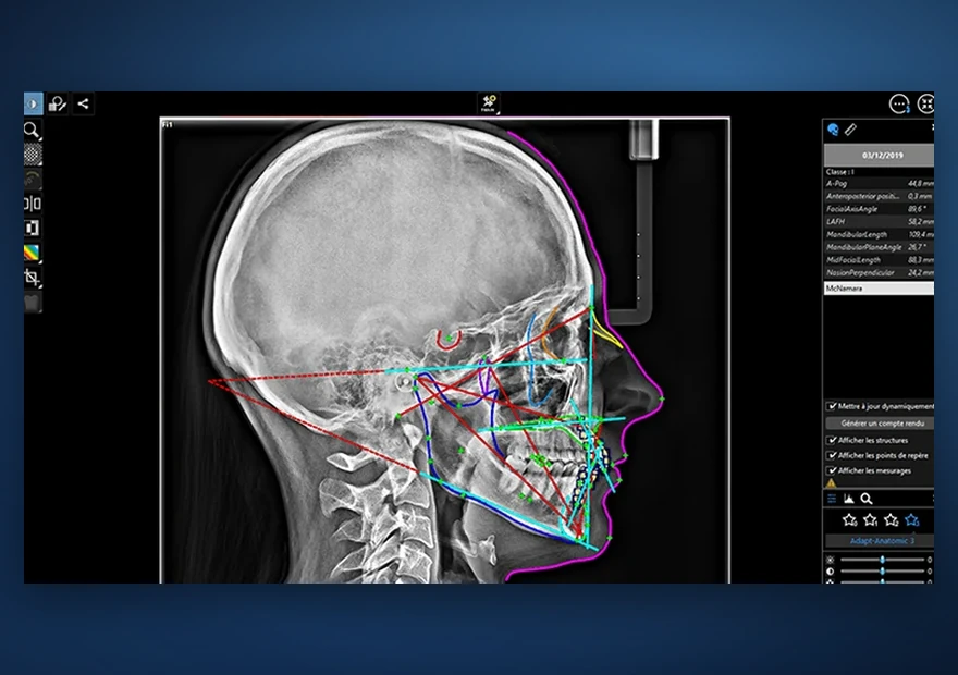 Análise cefalométrica sobre telerradiografia de perfil