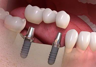 Arcada completa sobre implantes — esquema 3D