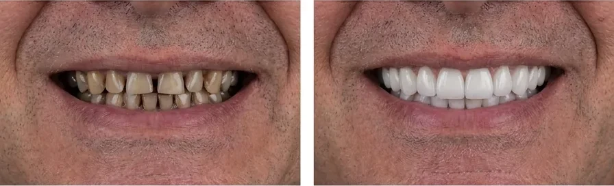 Caso de facetas dentárias — antes e depois
