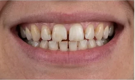 Sorriso antes do tratamento