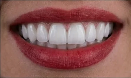 Sorriso depois do tratamento