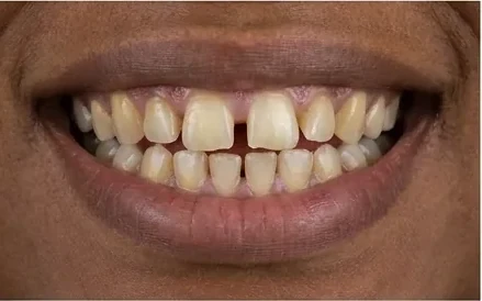 Sorriso antes do tratamento