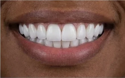 Sorriso depois do tratamento
