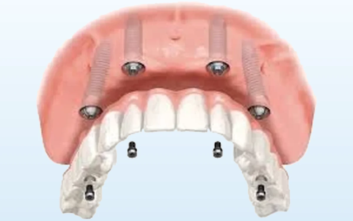 Representação de uma arcada fixa suportada por quatro implantes dentários