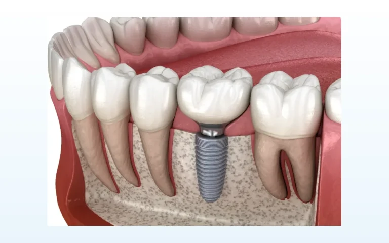 Quanto custa um implante dentário em Alcochete?
