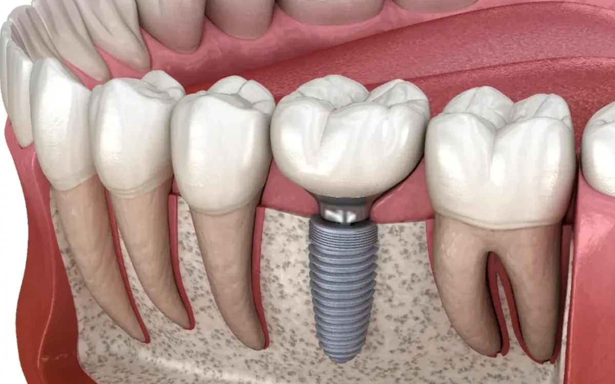Representação de um implante dentário unitário integrado no osso maxilar
