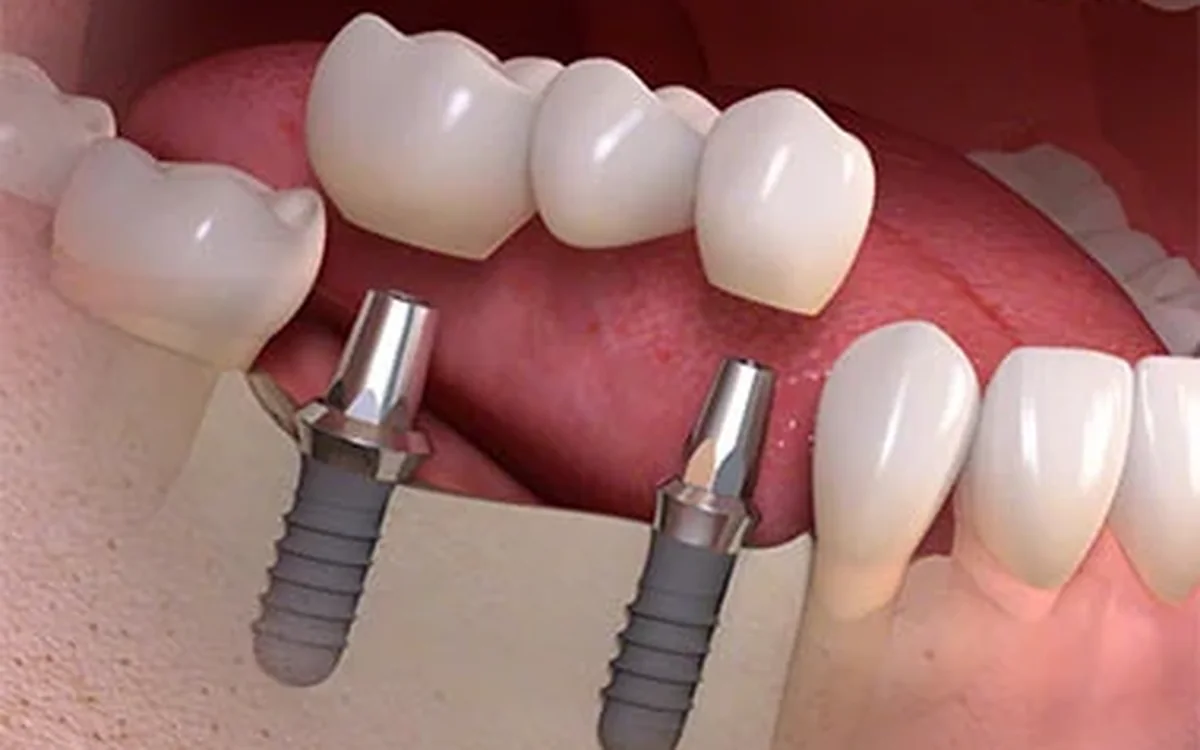 Representação de uma ponte fixa suportada por dois implantes dentários