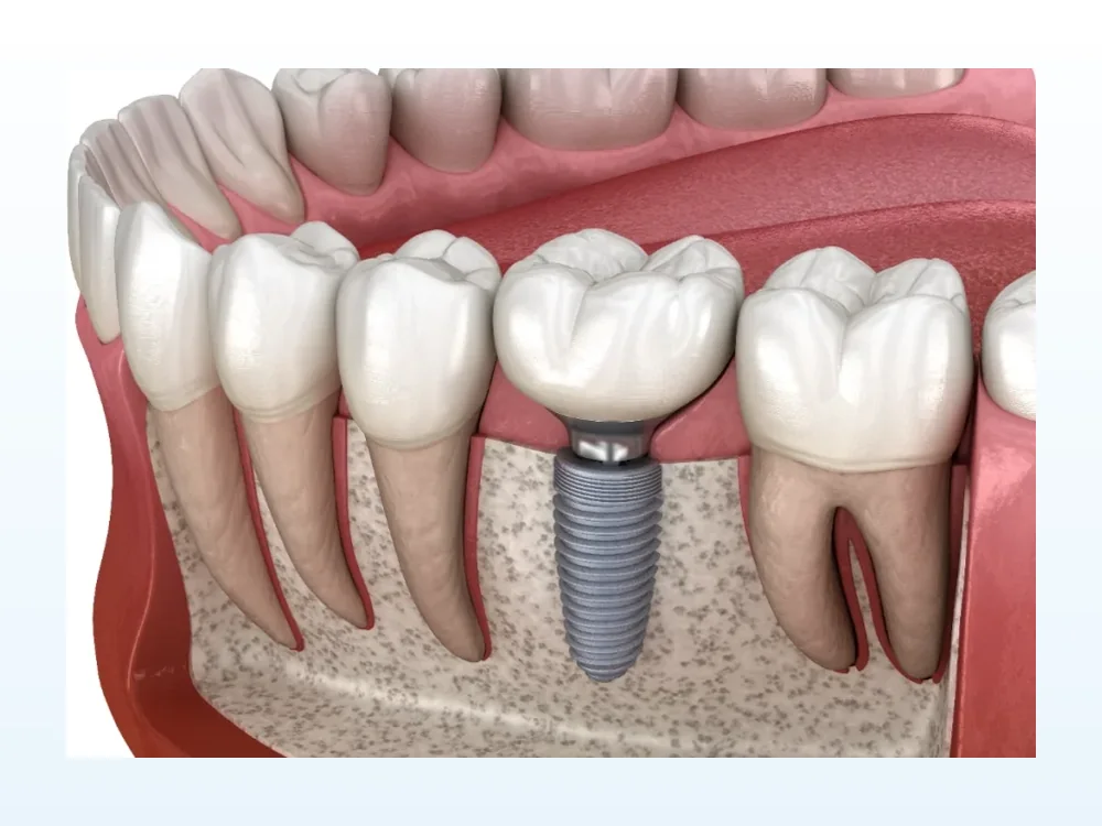 Representação tridimensional de um implante dentário unitário integrado no osso maxilar