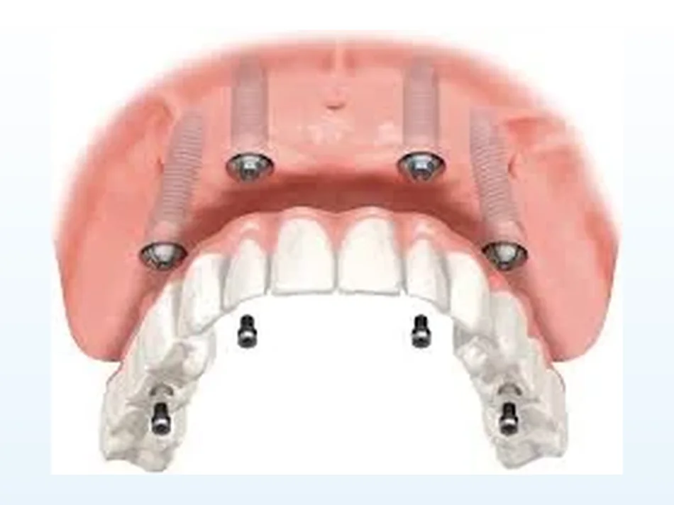Representação de uma arcada fixa suportada por quatro implantes dentários