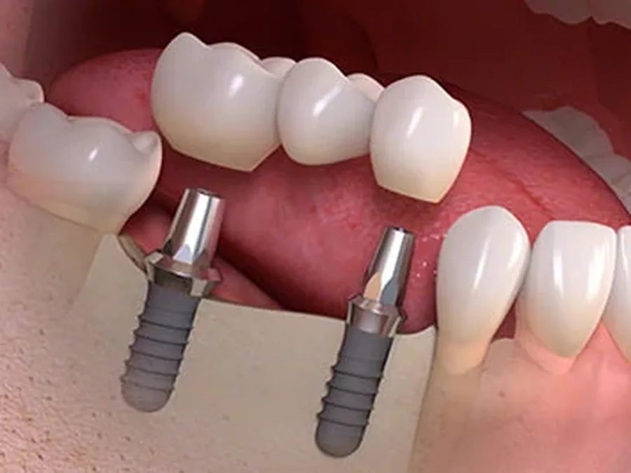 Representação de uma ponte fixa suportada por dois implantes dentários